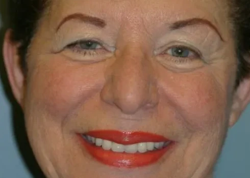 Kathy smiling after full-arch dental implants